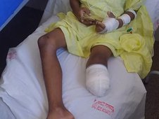 _Criança com perna amputada após acidente com ônibus escolar (Foto: Divulgação)
