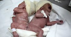 Gêmeos siameses nascem unidos pelo sacro; médica diz que caso é 'raro'