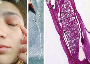 Verme vivo de 11 cm é retirado da pálpebra de mulher na Romênia