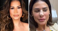 Outra pessoa! Simone Mendes surpreende com resultado de rinoplastia